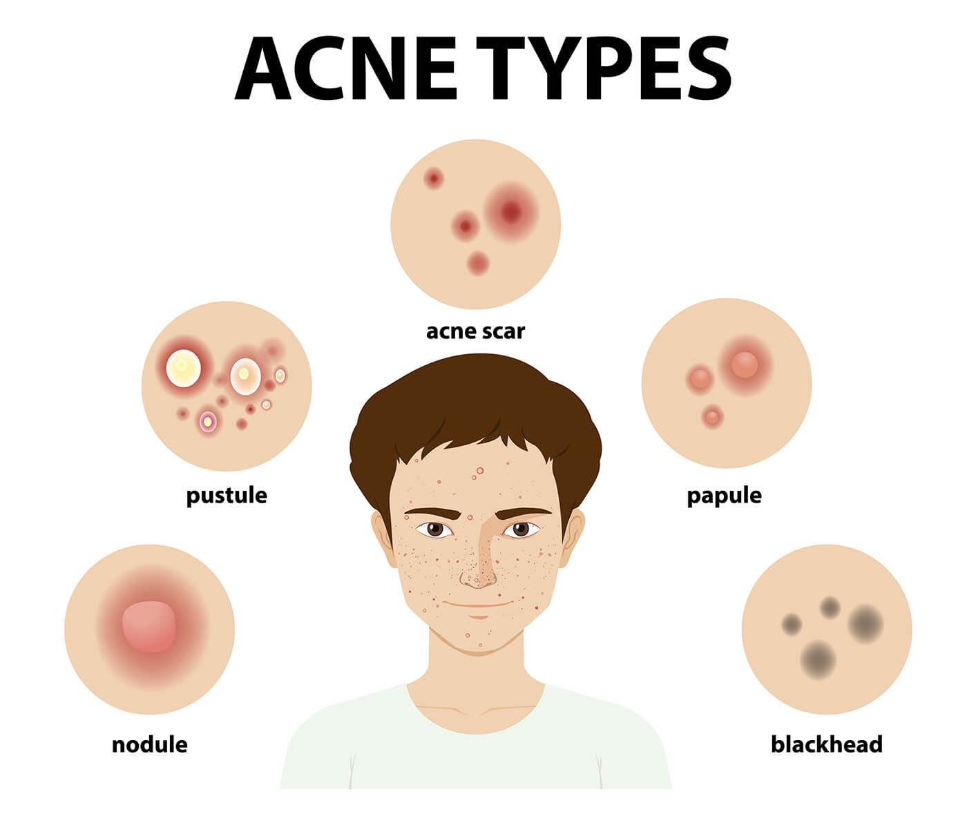 skincare acne treatments great barr