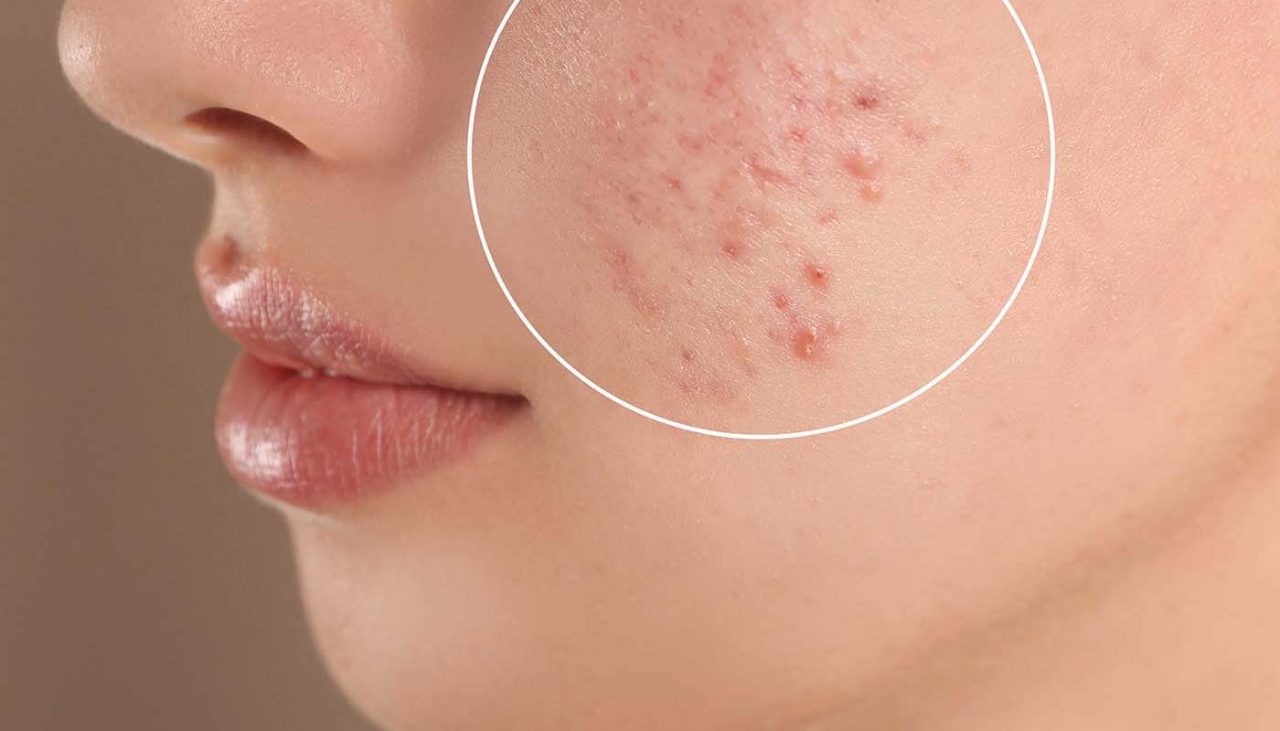 skincare acne remedy great barr